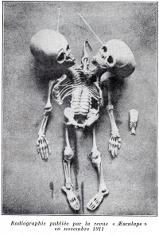 Soeurs siamoises - Radiographie